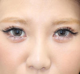 20代女性のヒアルロン酸注射（アゴ形成） After 症例写真