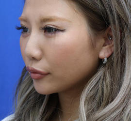 20代女性のヒアルロン酸注射（アゴ形成） After 症例写真