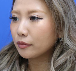 20代女性のヒアルロン酸注射（アゴ形成） Before 症例写真