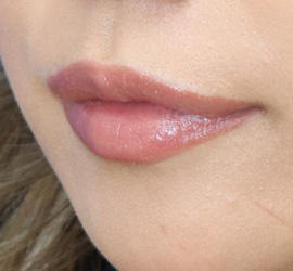 20代女性のヒアルロン酸注射（アゴ形成） Before 症例写真