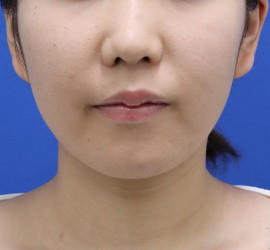 20代女性の顔の脂肪吸引 After 症例写真