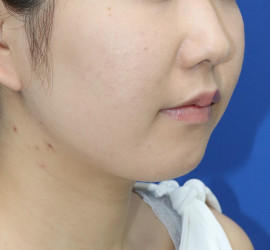 20代女性の顔の脂肪吸引  After 症例写真