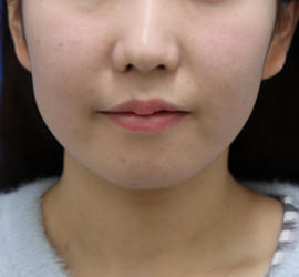 20代女性の顔の脂肪吸引 Before 症例写真