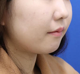 20代女性の顔の脂肪吸引  Before 症例写真