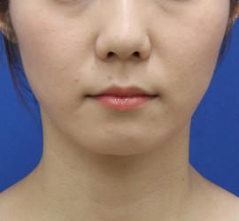 20代女性の顔の脂肪吸引 After 症例写真