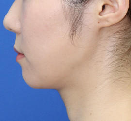 20代女性の顔の脂肪吸引  After 症例写真