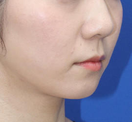 20代女性の顔の脂肪吸引  After 症例写真