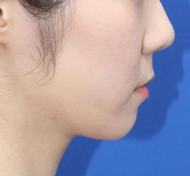 20代女性の顔の脂肪吸引  After 症例写真