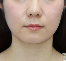 20代女性の顔の脂肪吸引 Before 症例写真