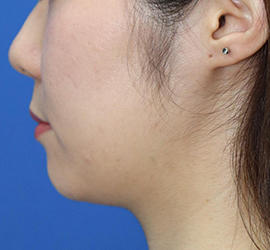 20代女性の顔の脂肪吸引  Before 症例写真