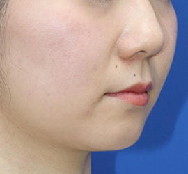 20代女性の顔の脂肪吸引  Before 症例写真