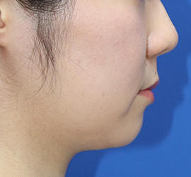 20代女性の顔の脂肪吸引  Before 症例写真