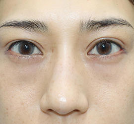 20代女性の二重整形・目元の整形 After 症例写真