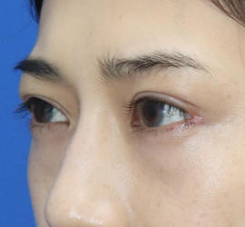 20代女性の全切開二重まぶた法 After 症例写真