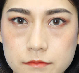 20代女性の全切開二重まぶた法 After 症例写真