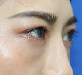 20代女性の全切開二重まぶた法 After 症例写真