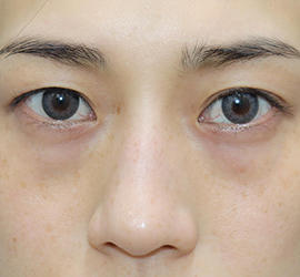 20代女性の二重整形・目元の整形 Before 症例写真