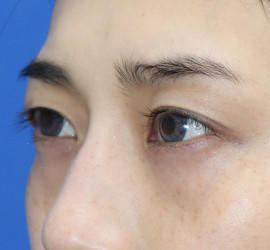 20代女性の全切開二重まぶた法 Before 症例写真