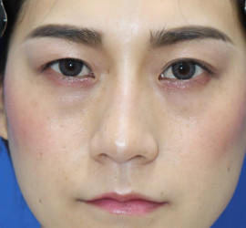 20代女性の全切開二重まぶた法 Before 症例写真