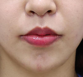 20代女性の人中短縮(リップリフト) After 症例写真