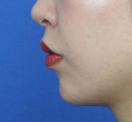 20代女性の人中短縮(リップリフト) After 症例写真