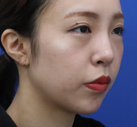 20代女性の人中短縮(リップリフト) After 症例写真