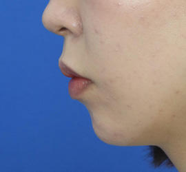 20代女性の人中短縮(リップリフト) Before 症例写真