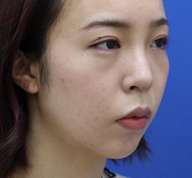 20代女性の人中短縮(リップリフト) Before 症例写真