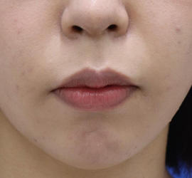 20代女性の人中短縮(リップリフト) Before 症例写真