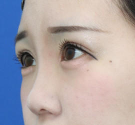 20代女性の眼瞼下垂 After 症例写真