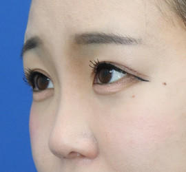 20代女性の眼瞼下垂 Before 症例写真