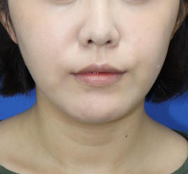 20代女性の顔の脂肪吸引  After 症例写真