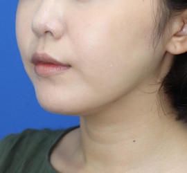 20代女性の顔の脂肪吸引 After 症例写真