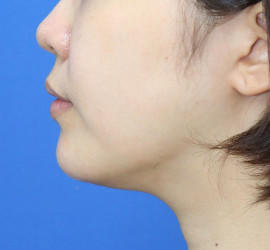 20代女性の顔の脂肪吸引  After 症例写真