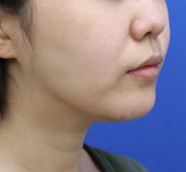 20代女性の顔の脂肪吸引  After 症例写真