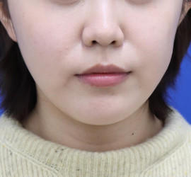 20代女性の顔の脂肪吸引  Before 症例写真