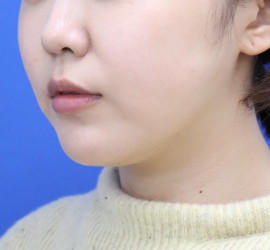 20代女性の顔の脂肪吸引 Before 症例写真
