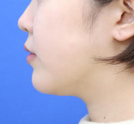 20代女性の顔の脂肪吸引  Before 症例写真