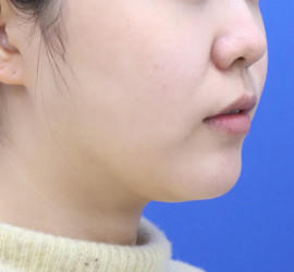 20代女性の顔の脂肪吸引  Before 症例写真