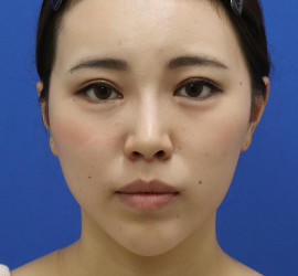 20代女性の唇・口元の整形 After 症例写真