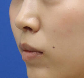 20代女性の人中短縮（リップリフト） After 症例写真