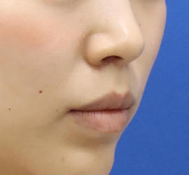20代女性の人中短縮（リップリフト） After 症例写真