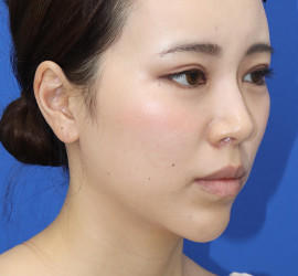 20代女性の人中短縮（リップリフト） After 症例写真