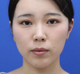 20代女性の唇・口元の整形 Before 症例写真