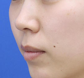 20代女性の人中短縮（リップリフト） Before 症例写真