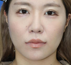 20代女性の耳介軟骨移植 After 症例写真