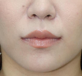 20代女性の人中短縮(リップリフト) After 症例写真