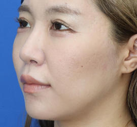 20代女性の人中短縮(リップリフト) After 症例写真