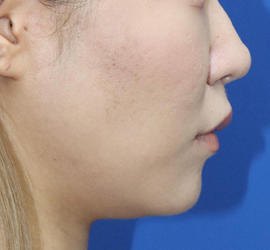 20代女性の人中短縮(リップリフト) After 症例写真