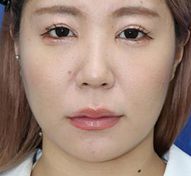 20代女性の耳介軟骨移植 Before 症例写真